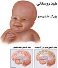 كاردرمانى فلج مغزى
